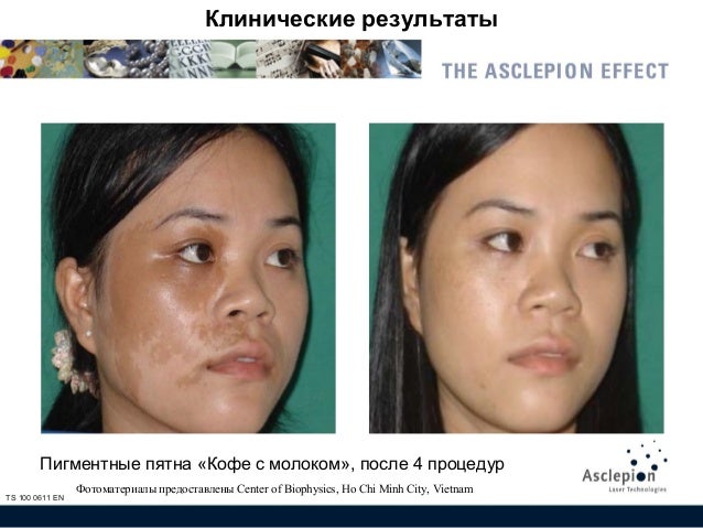 От чего пегментация кожи От чего пегментация кожи